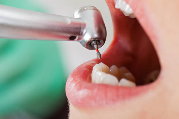 Best Chipped Tooth Repair Near Me  in Hoover, AL
